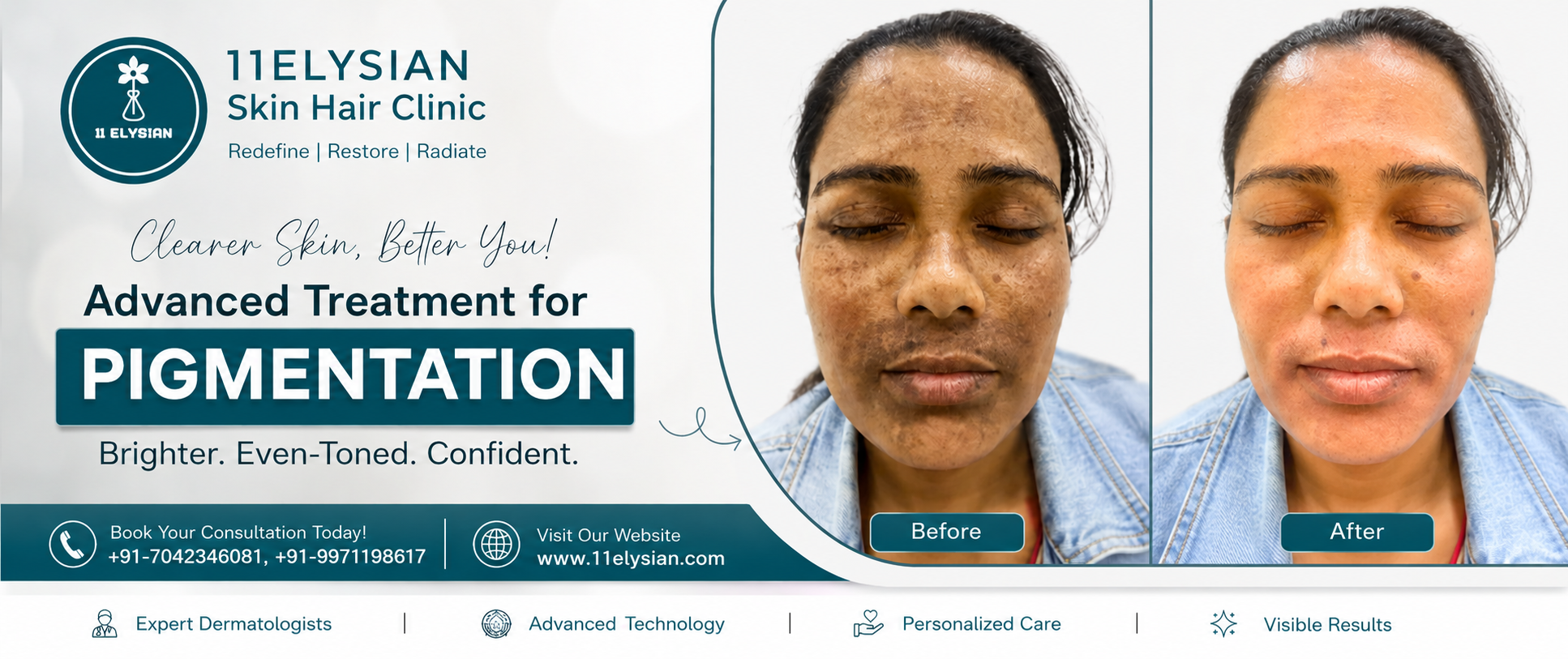 Pigmentation Treatment Near Gaur City 1, Greater Noida West